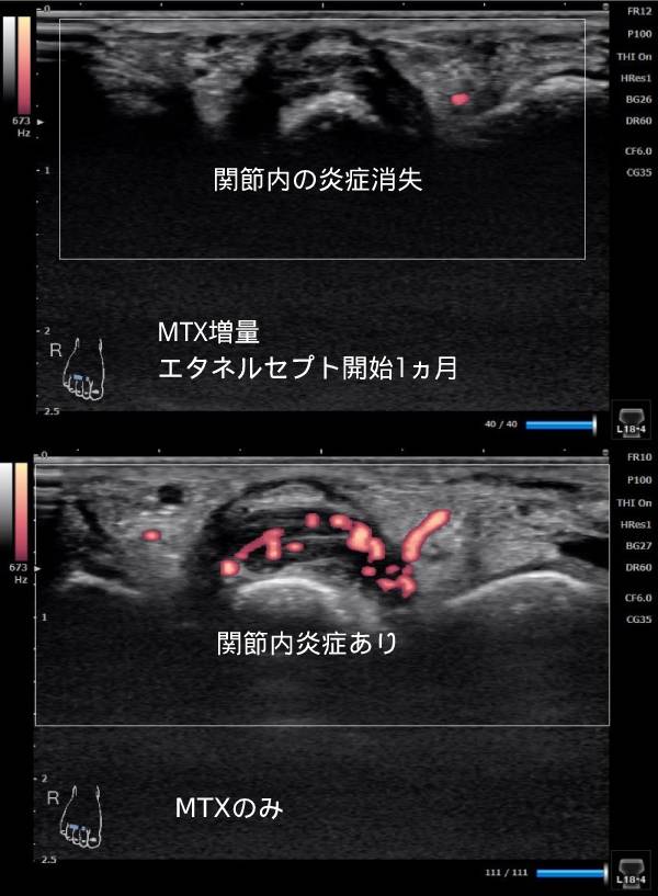 エタネルセプト治療1ヵ月で炎症消失のエコー画像